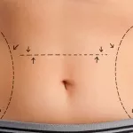 عملية شفط الدهون - كل ما تريد معرفته عن عمليات شفط الدهون