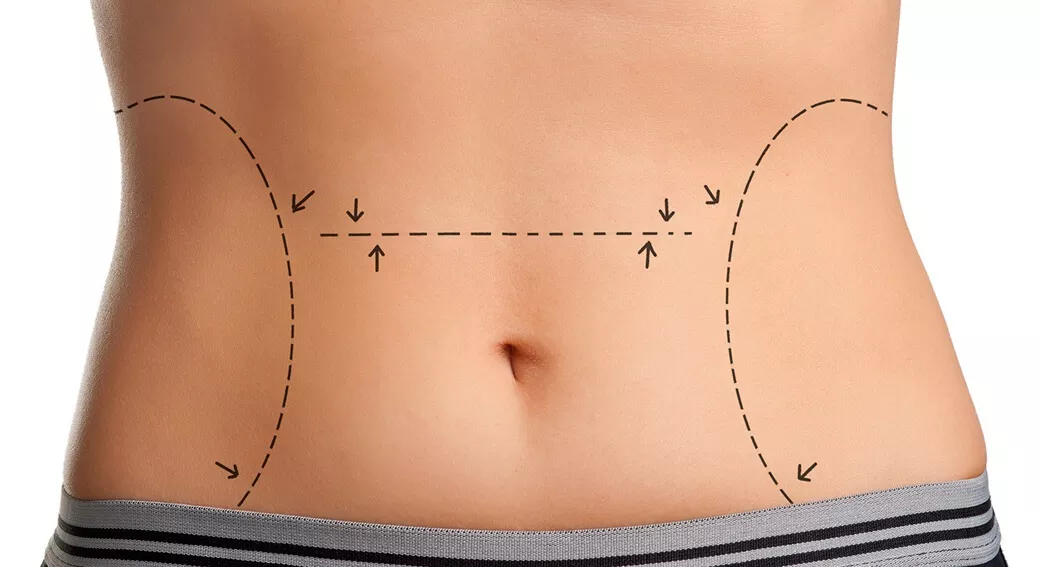 عملية شفط الدهون – كل ما تريد معرفته عن عمليات شفط الدهون