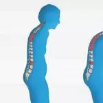 هشاشة العظام -  أسباب الإصابة به وكيف تحمي نفسك من الاصابة به