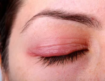الأكياس الدهنية تحت العين (البردة) – اعراضها والاسباب وراء ظهورها وكيفية علاجها بالطرق الطبيعية