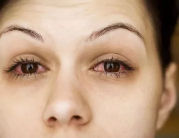 زغللة العين – تعرف على اسباب زغللة العين واعراضها وطرق علاجها