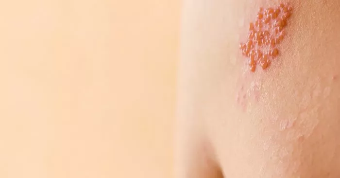 الحزام الناري أو زنار النار : أعراضه وأسباب حدوثه وكيفية علاجه 2 الحزام الناري