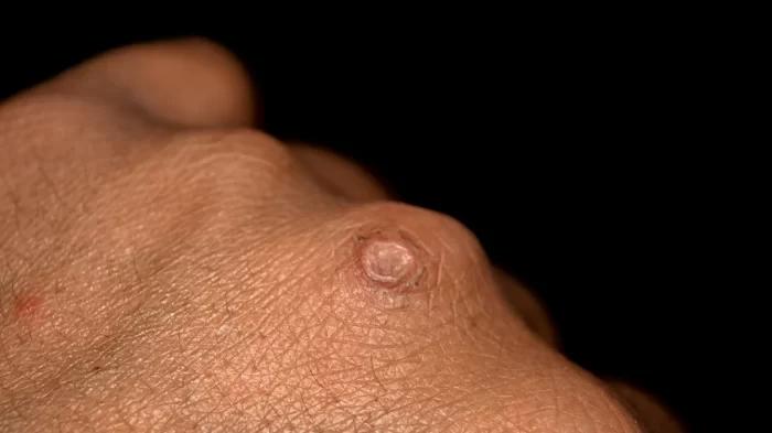 الثآليل أسبابها وطرق علاجها 4 الثآليل المسطحة