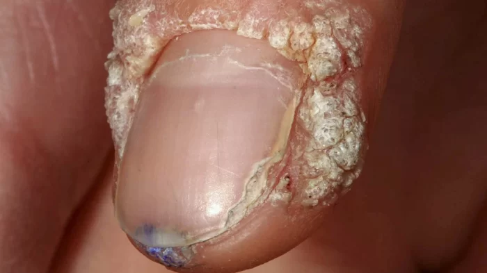 الثآليل أسبابها وطرق علاجها 6 Periungual warts