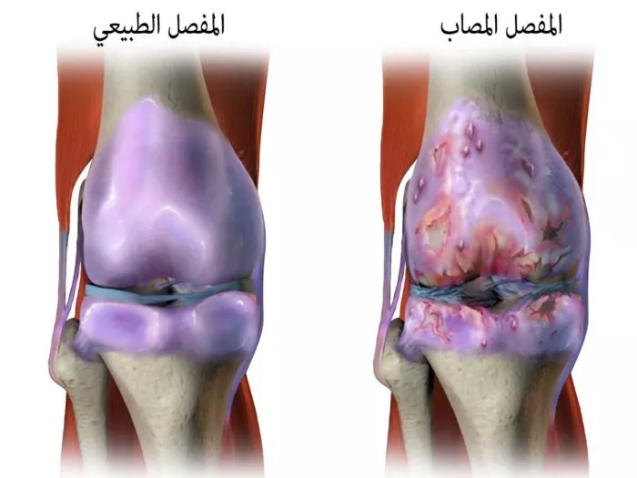 الأسباب ال12 المحتملة لتصلب المفاصل وماذا تفعل حيالها 2 خشونة المفاصل