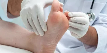 مسمار القدم –  اسباب ظهوره، وكيفية علاجه بالطرق الطبيعية