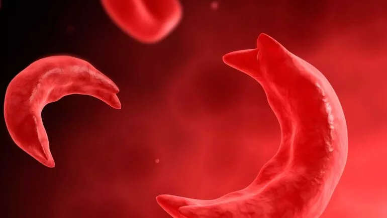 مرض فقر الدم المنجلي أو أنيميا الخلايا المنجلية
