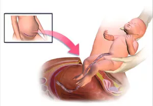 الولادة القيصرية : ما يجب عليك معرفته قبل الولادة 3 الولادة القيصرية