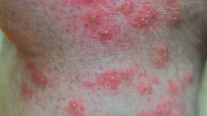 لدغات النمل