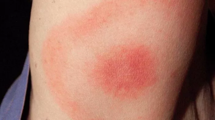 لدغة القراد