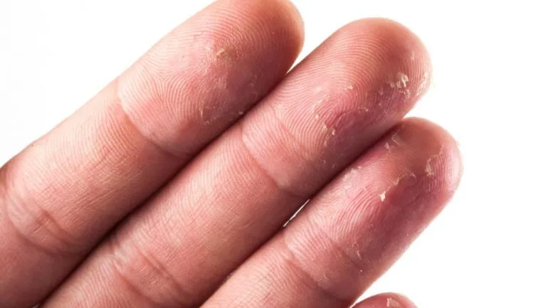 تقشير اطراف الأصابع : 12 سبب و علاجات لحماية جلد الاصابع
