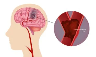 علامات وأعراض النوبة الدماغية الصغرى أو النوبة الإقفارية العابرة