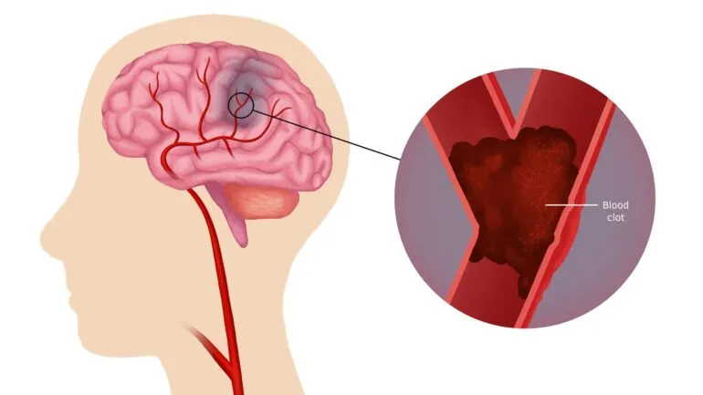 علامات وأعراض النوبة الدماغية الصغرى أو النوبة الإقفارية العابرة