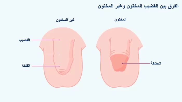 الختان - ما تحتاج لمعرفته حول ختان الذكور