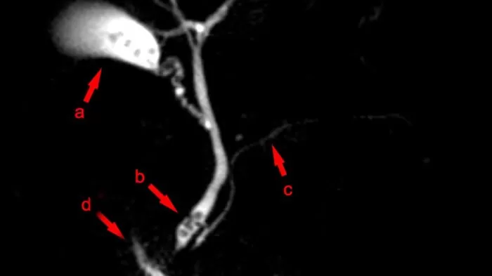 اليرقان - ما الذي يسبب بشرتي الصفراء؟ 23 مرض! 10 انسداد القناة الصفراوية