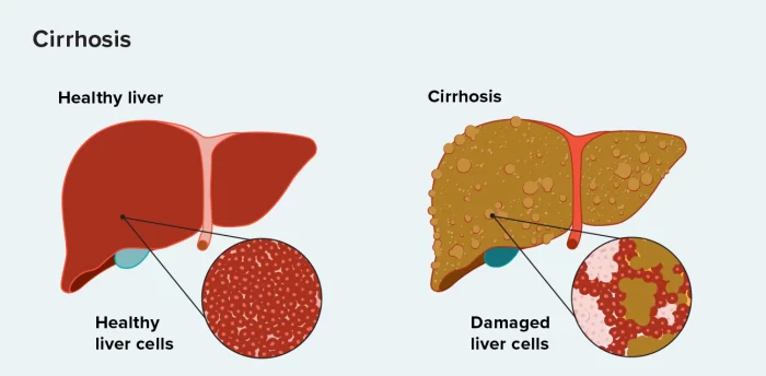 تليف الكبد 2 تليف الكبد