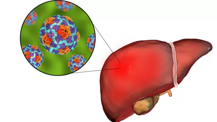 اليرقان - ما الذي يسبب بشرتي الصفراء؟ 23 مرض! 8 التهاب الكبد أ