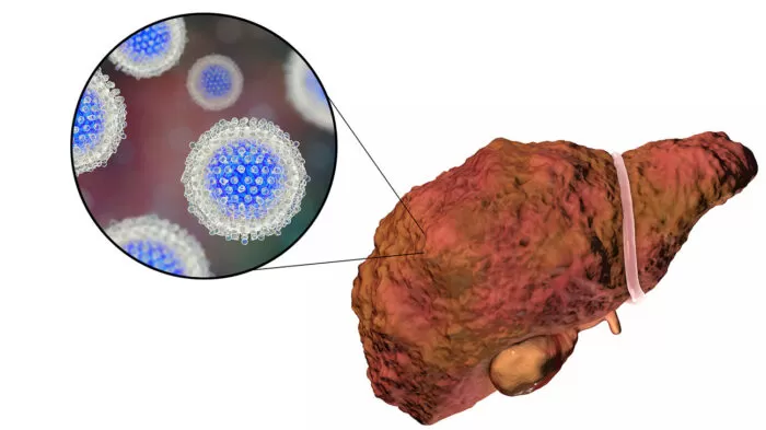 اليرقان - ما الذي يسبب بشرتي الصفراء؟ 23 مرض! 5 التهاب الكبد الوبائي سي