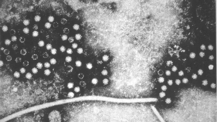 اليرقان - ما الذي يسبب بشرتي الصفراء؟ 23 مرض! 6 التهاب الكبد أي
