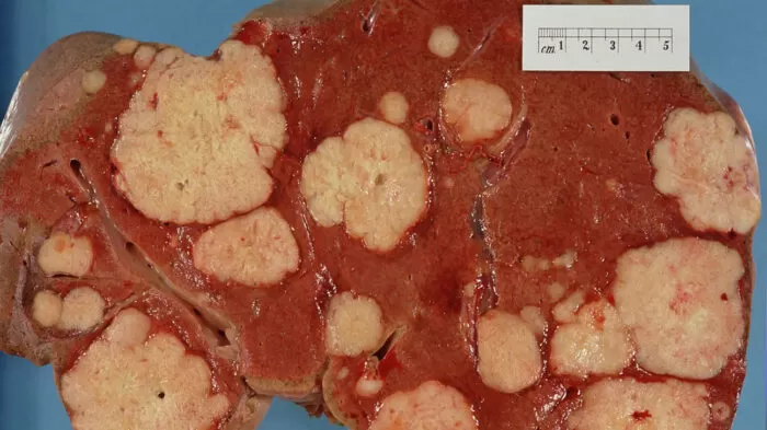 اليرقان - ما الذي يسبب بشرتي الصفراء؟ 23 مرض! 12 سرطان الكبد