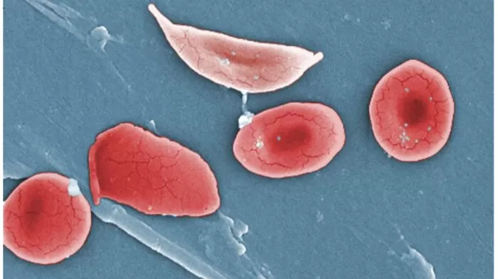 اليرقان - ما الذي يسبب بشرتي الصفراء؟ 23 مرض! 11 فقر الدم المنجلي