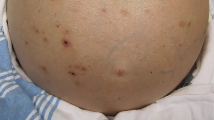 اليرقان - ما الذي يسبب بشرتي الصفراء؟ 23 مرض! 9 تليف الكبد