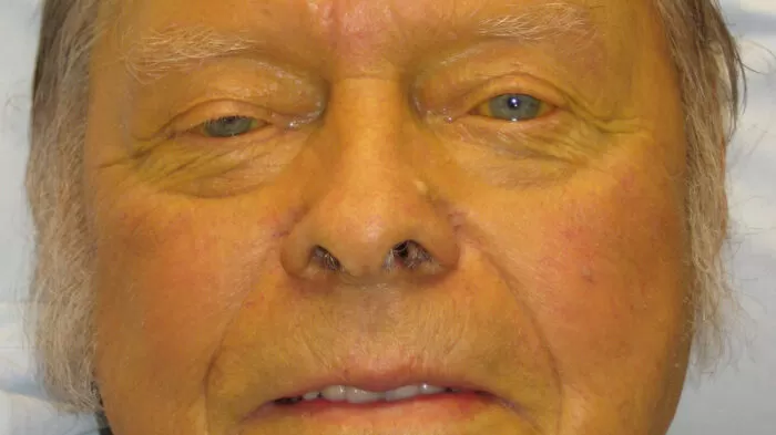 اليرقان - ما الذي يسبب بشرتي الصفراء؟ 23 مرض! 3 سرطان البنكرياس