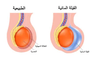 القيلة المائية