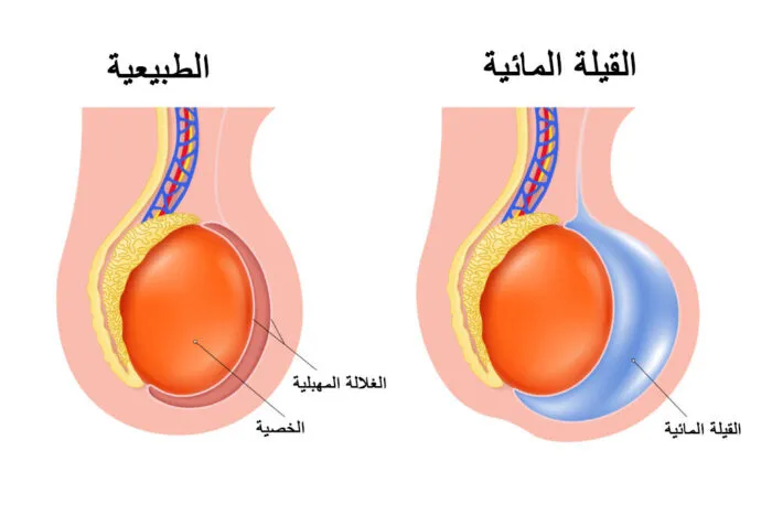 القيلة المائية: الأسباب والأعراض والعلاج 2 القيلة المائية