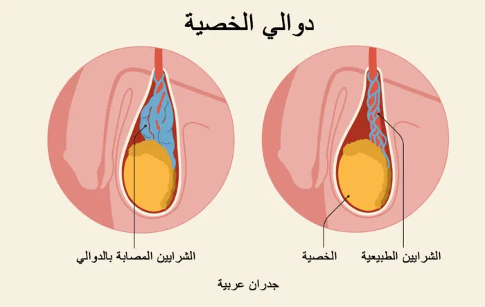 دوالي الخصية 2 دوالي الخصية